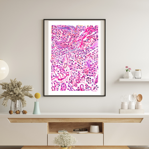 pancreas neoplasm art