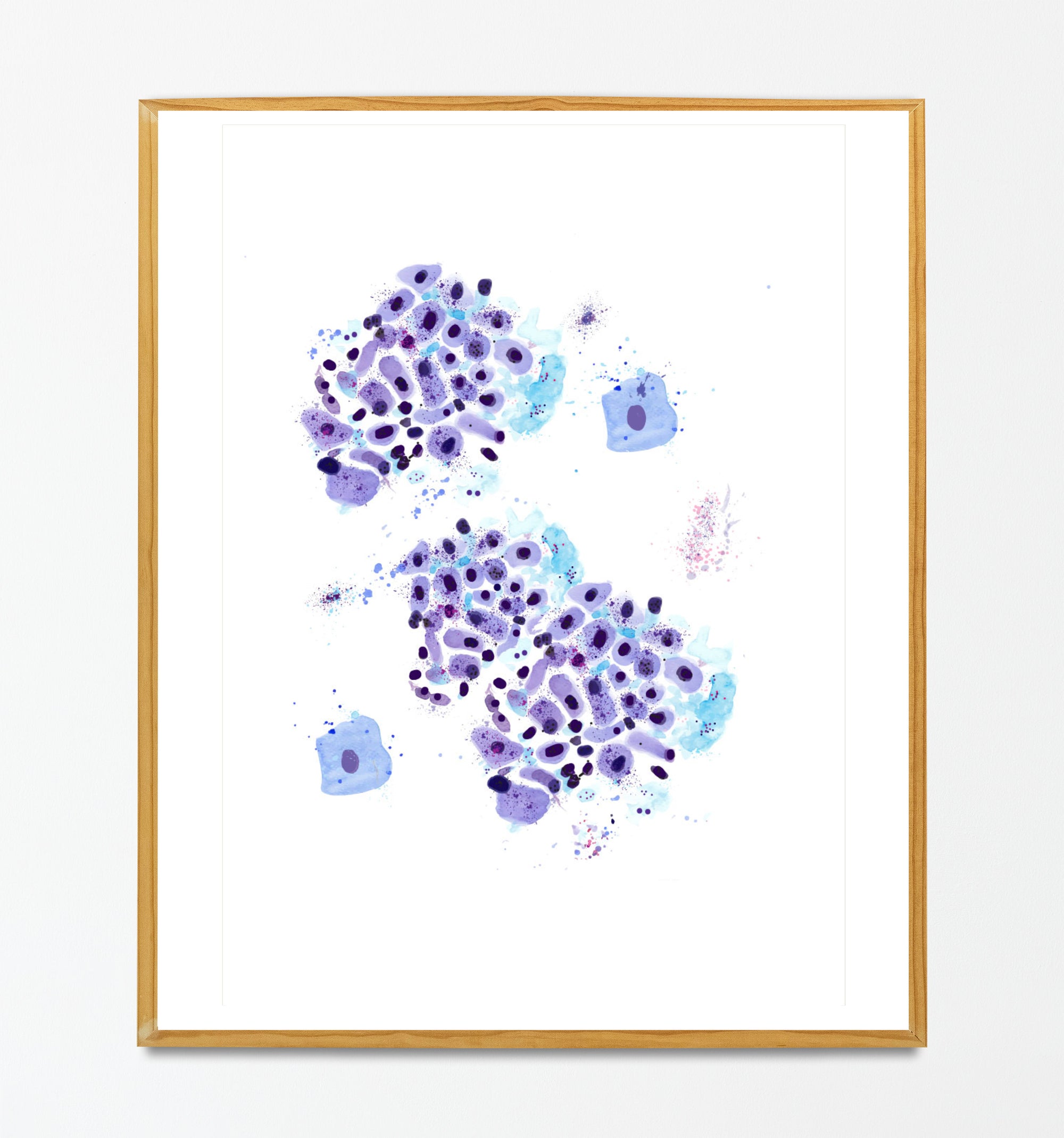 Esophageal Tumor Gastroenterology Pathology Cytology Oncolgy Art Print