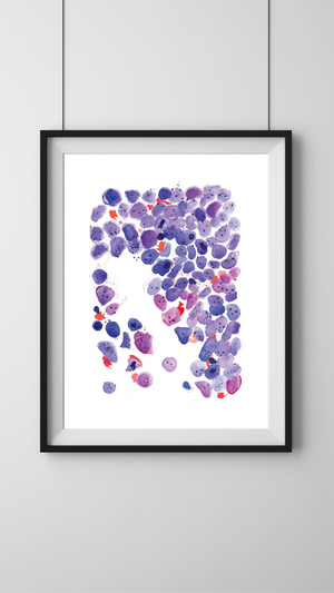 Acute Myeloid Leukemia Art Print, Hematopathology Art, Hematologist Office Art, Hematologist Gift, Pathologist Gift, Laboratory Artwork, AML