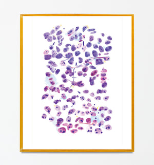 Prostate Adenocarcinoma, metastatic. Abstract Pathology Artwork, Histopathologist Gift