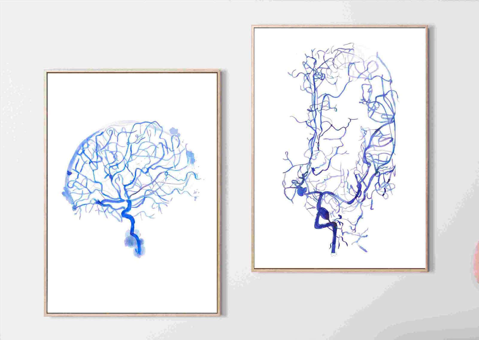 cerebral angiogram brain aneurysm art print

