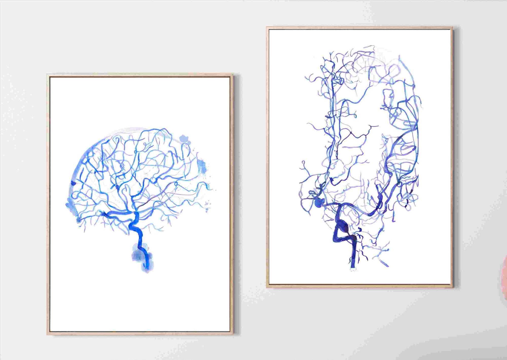 Cerebral Angiography, Cerebral Aneurysm, Set of 2