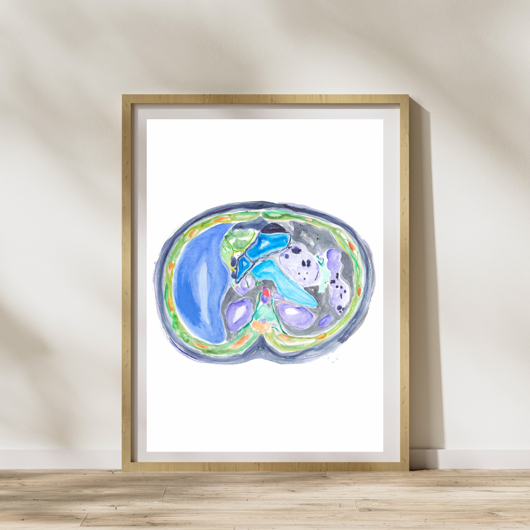 Abdominal CT Scan Cross Section Radiology Gastroenterology and Surgery Artwork