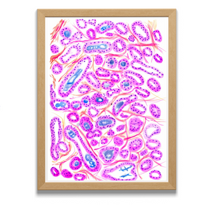 Prostate Adenocarcinoma Uropathology Art Print