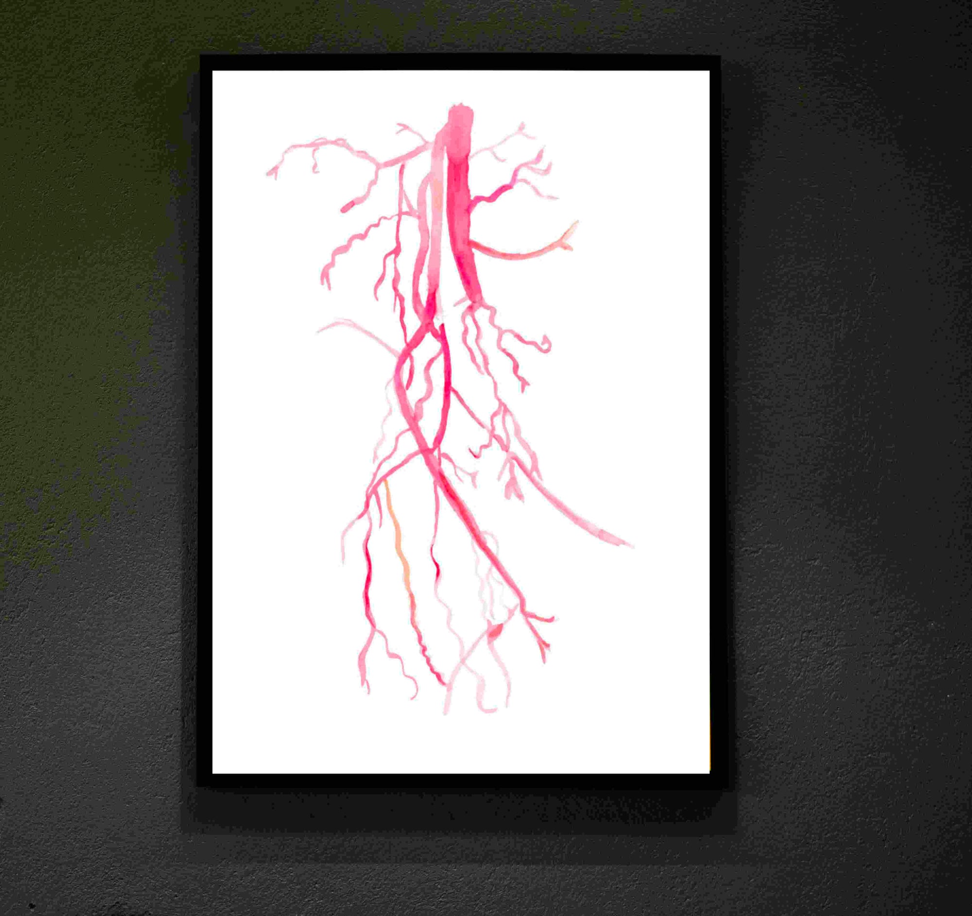 Angiography Femoral Spf Artery Occlusion Anatomy Art Print