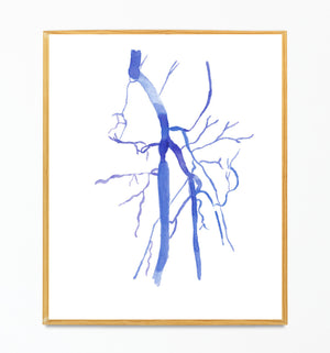 Femoral Artery Occlusion DSA Watercolor Anatomy Art Print