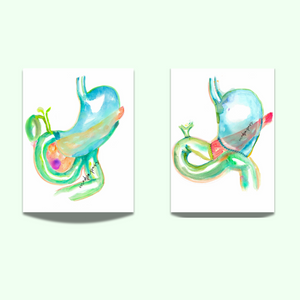 Pancreaticoduodenectomy - Whipple Procedure Art Before and After