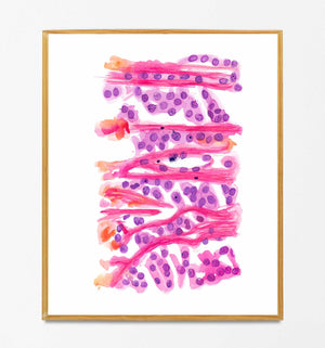Melanoma Nevus Skin Cancer Histopathology Watercolor Painting