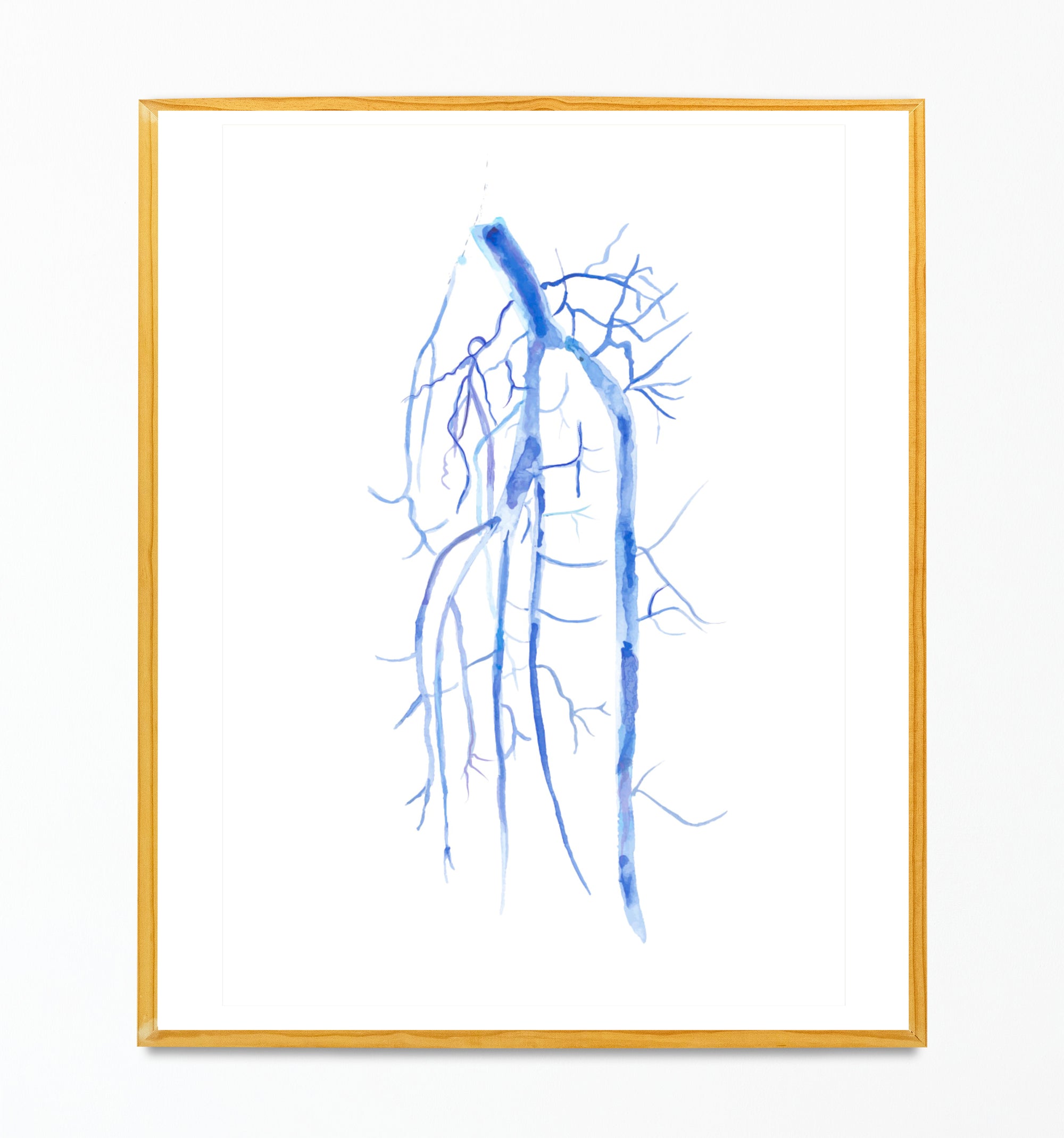 Popliteo-tibial Angiography Art Print