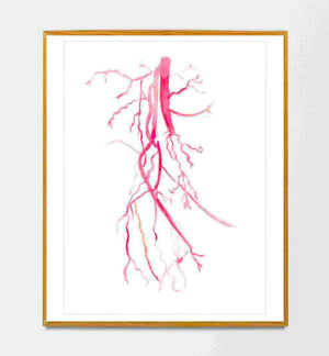 Angiography Femoral Spf Artery Occlusion Anatomy Art Print