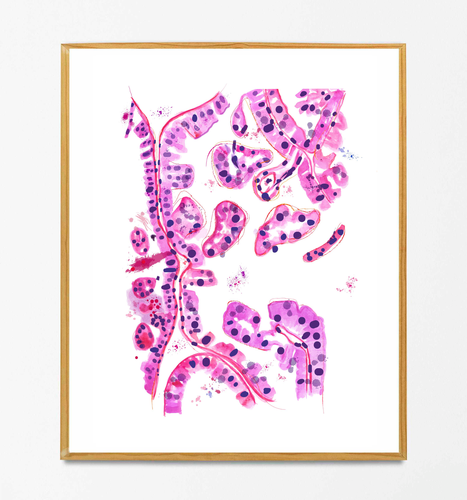 thyroid papillary cancer watercolor art print