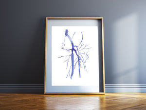 Femoral Artery Occlusion DSA Watercolor Anatomy Art Print