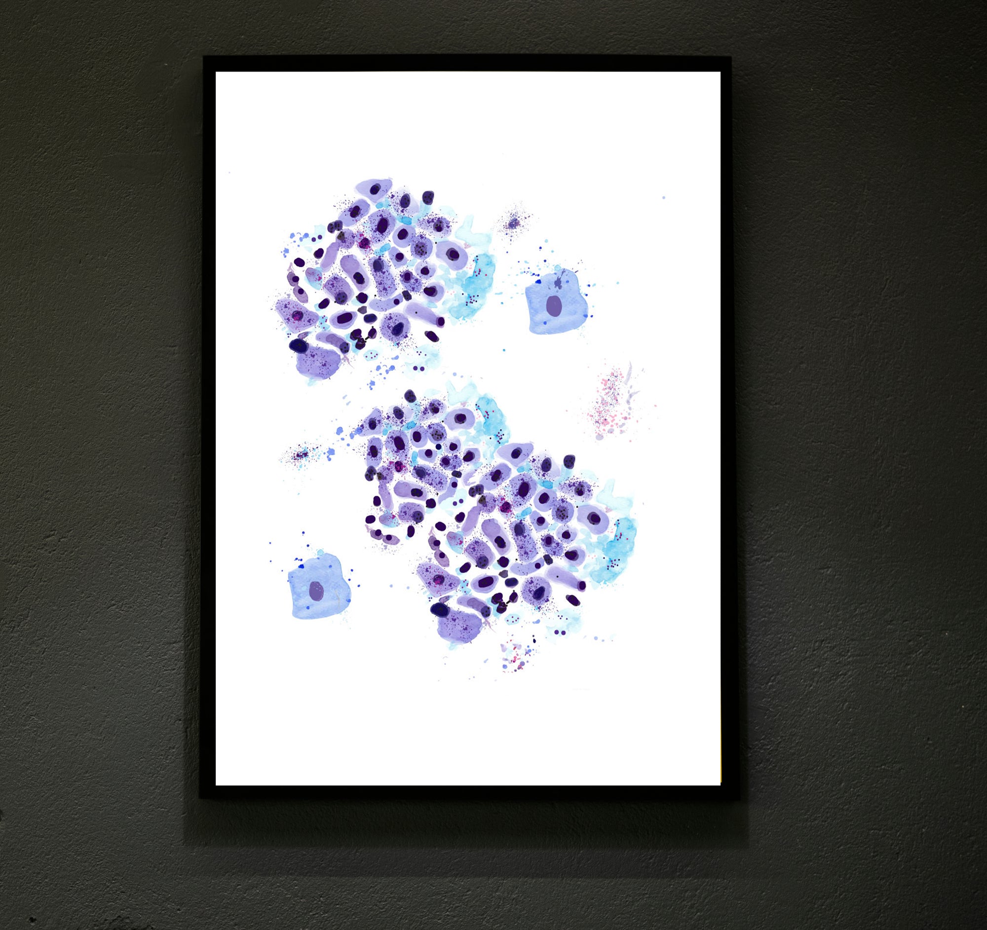 Esophageal Tumor Gastroenterology Pathology Cytology Oncolgy Art Print