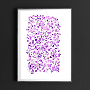 Anaplastic Large Cell Lymphoma Print, Abstract Pathology Art