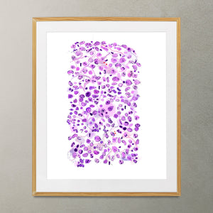 Anaplastic Large Cell Lymphoma Print, Abstract Pathology Art