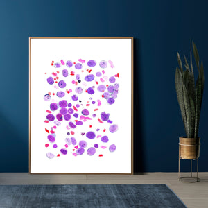 Acute Lymphoblastic Leukemia Hematooncology Art Print