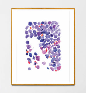 Acute Myeloid Leukemia Art Print, Hematopathology Art, Hematologist Office Art, Hematologist Gift, Pathologist Gift, Laboratory Artwork, AML