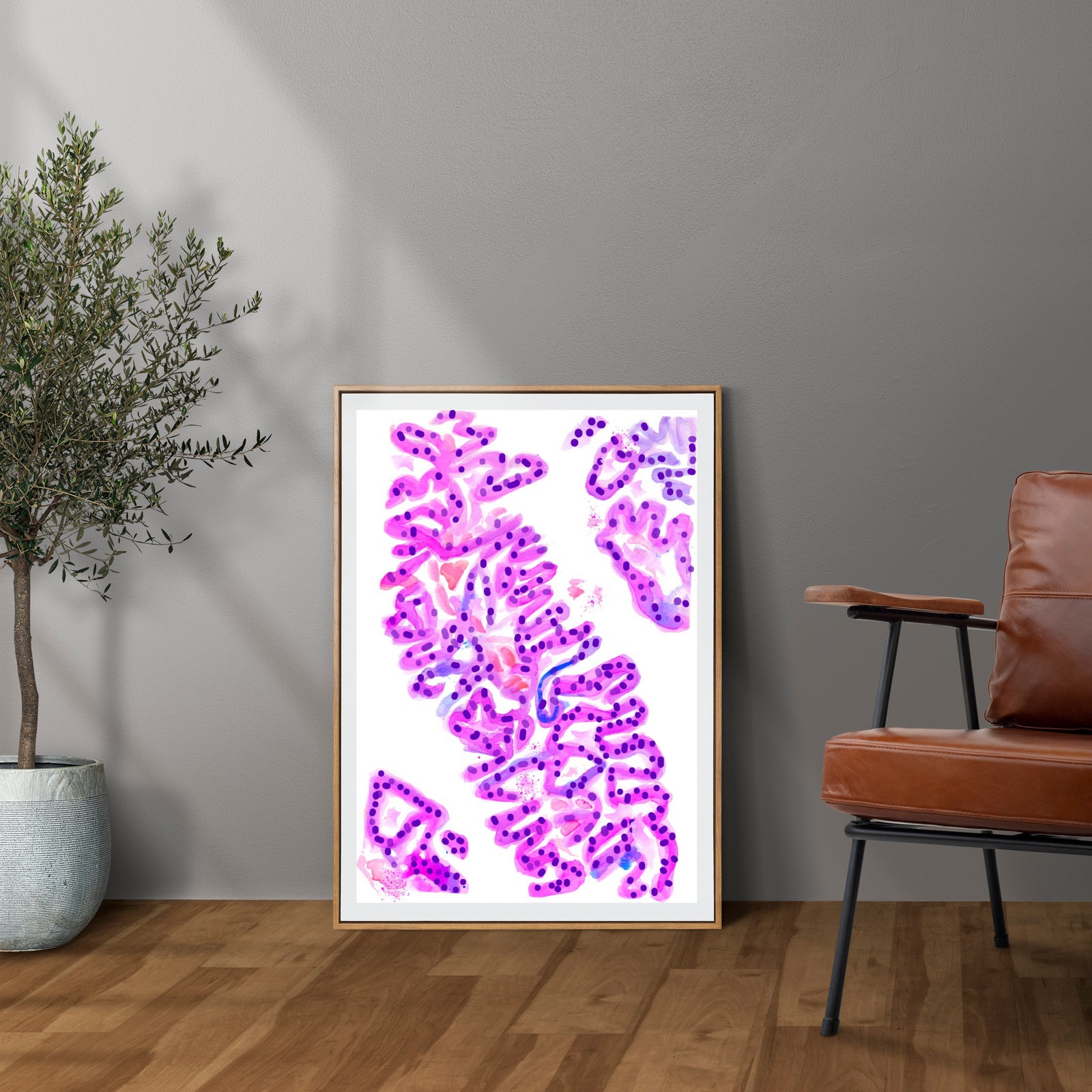 Urothelial Carcinoma Pathology Art