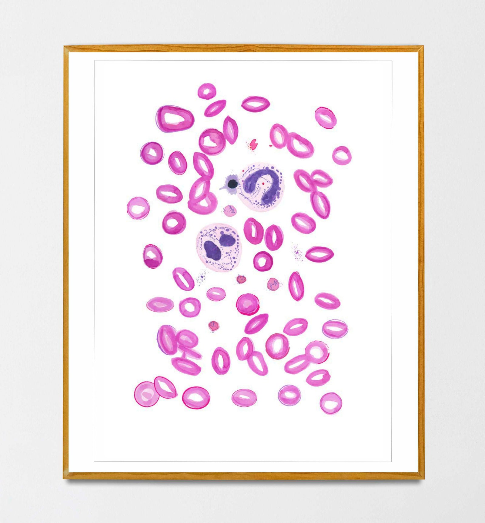Sickle Cell Anaemia, Anemia Art, Hematology Art, Hematologist Gift, Laboratory Art, Lab Tech Gift, Hematology Nurse, Hematology Gift